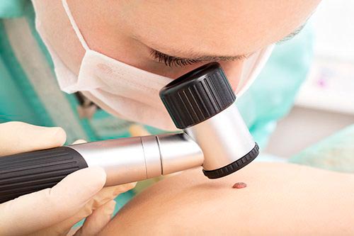 Ask the expert: Should I be worried about my mole?