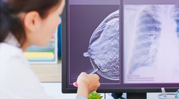 image_breastcancerstages