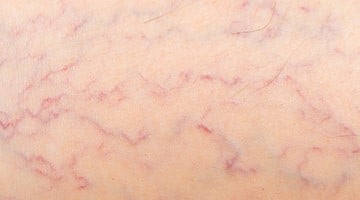 image_varicosecauses