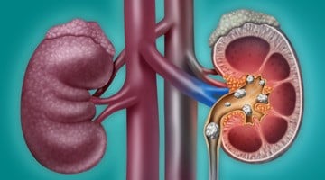 image_whatarekidneystones