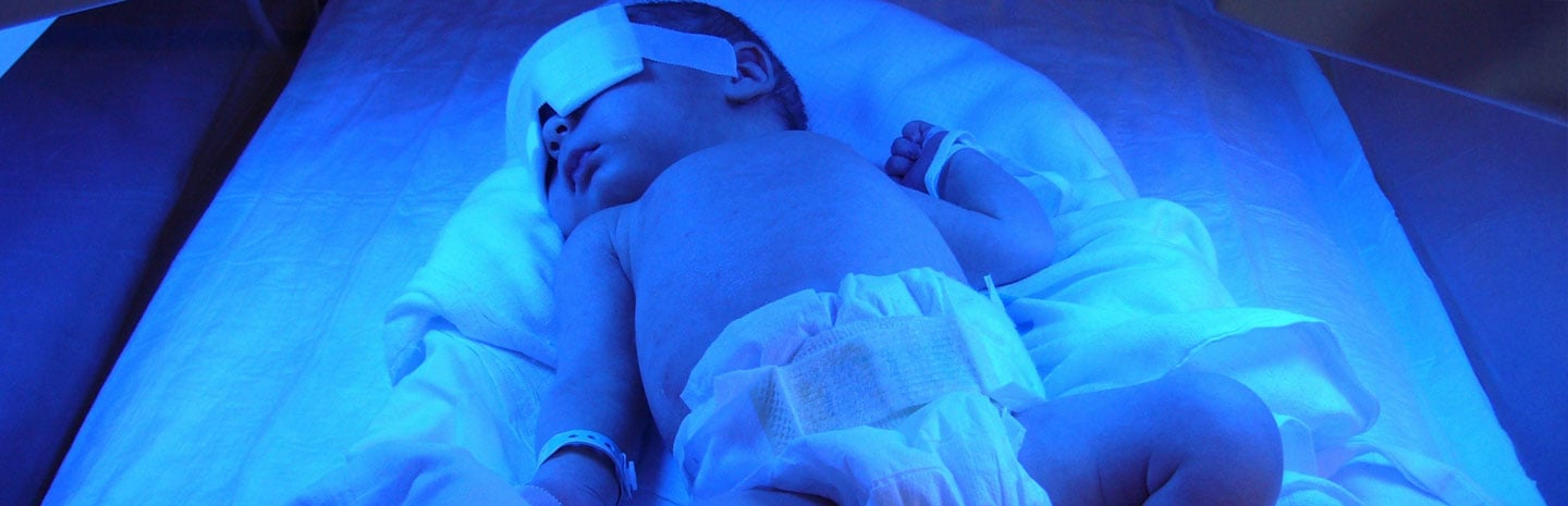 Jaundice in babies