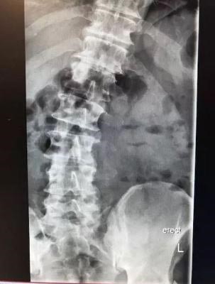 The x-ray of Tony's curved spine