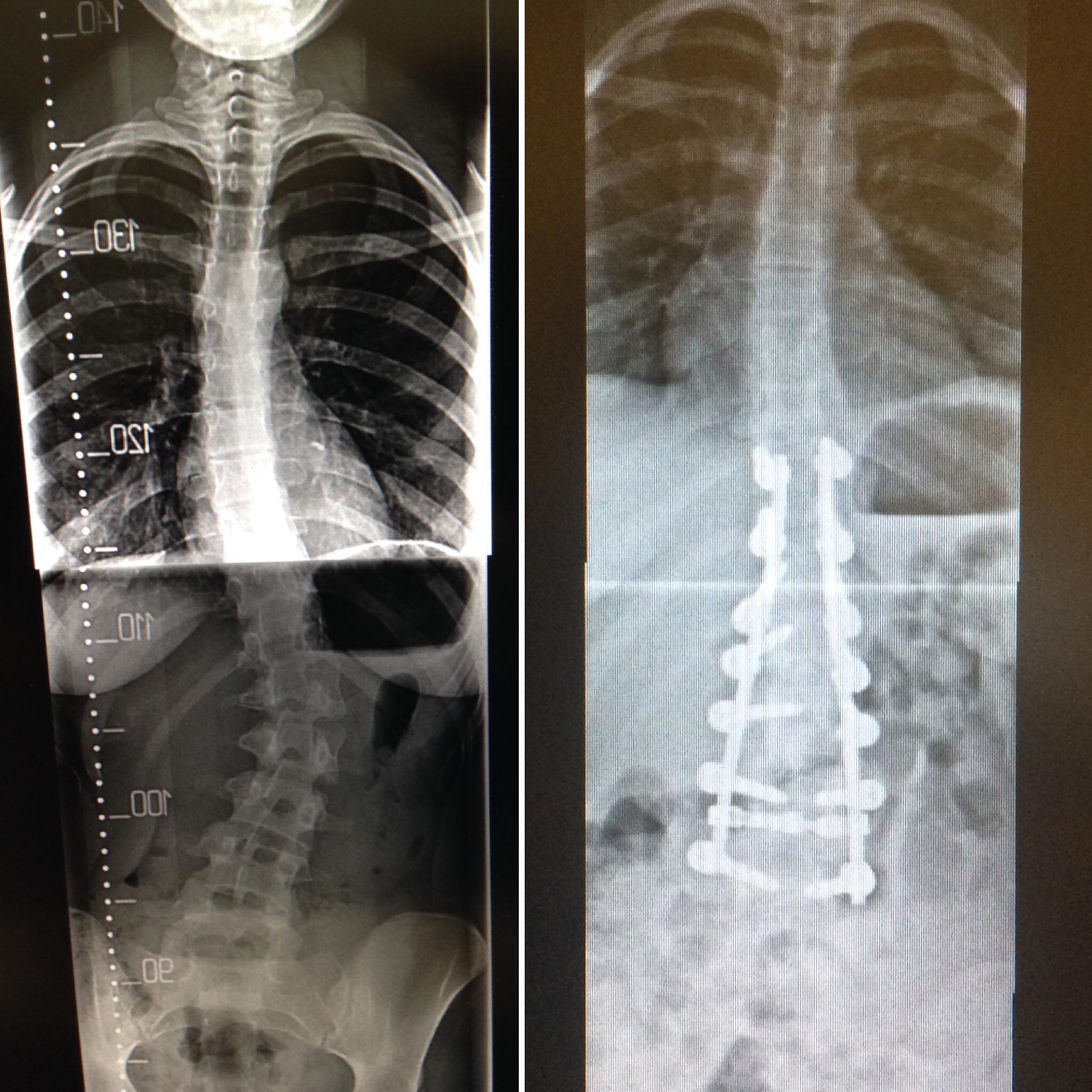 Teenage Scoliosis correction at Spire Southampton Hospital