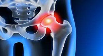 Are you considering hip replacement surgery?