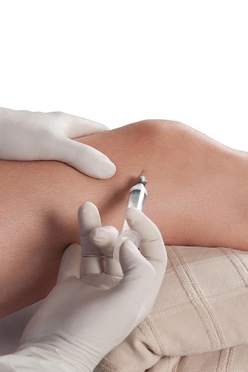 Knee arthritis