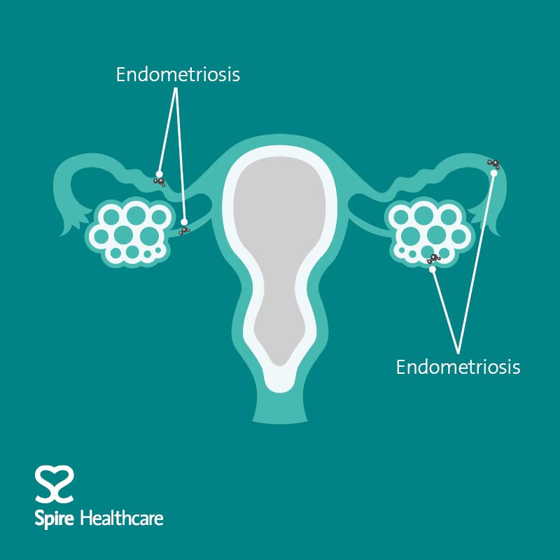 Endometriosis Clinic at Spire Edinburgh Hospitals