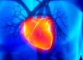 Arrhythmia