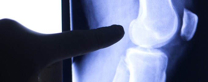 Image of a knee xray