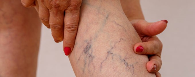 Image of someone suffering with varicose veins