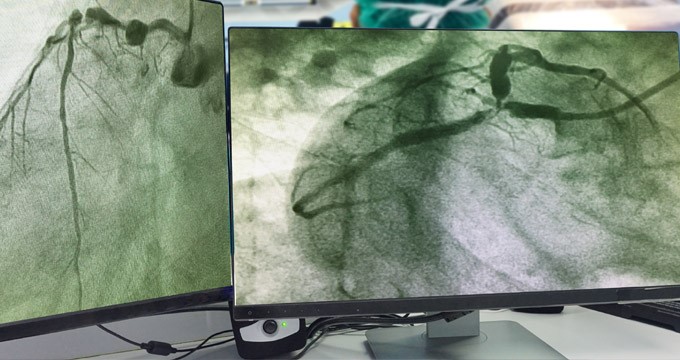 Screens showing angioplasty results