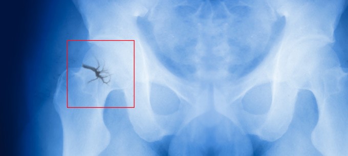 x-ray showing a fractured hip