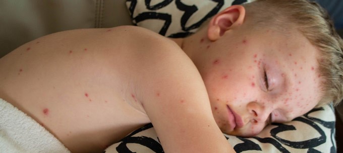 An exhausted child with chickenpox