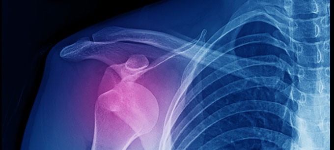 An x-ray image of a dislocated shoulder