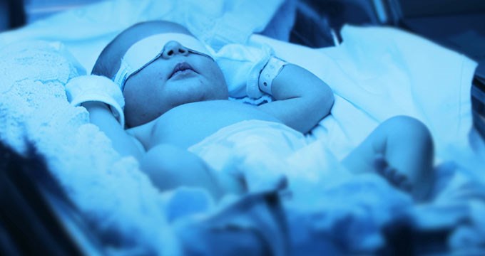 A baby receiving phototherapy