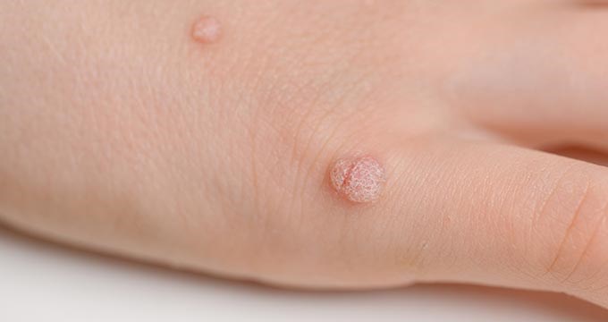 A close up of  hand with warts