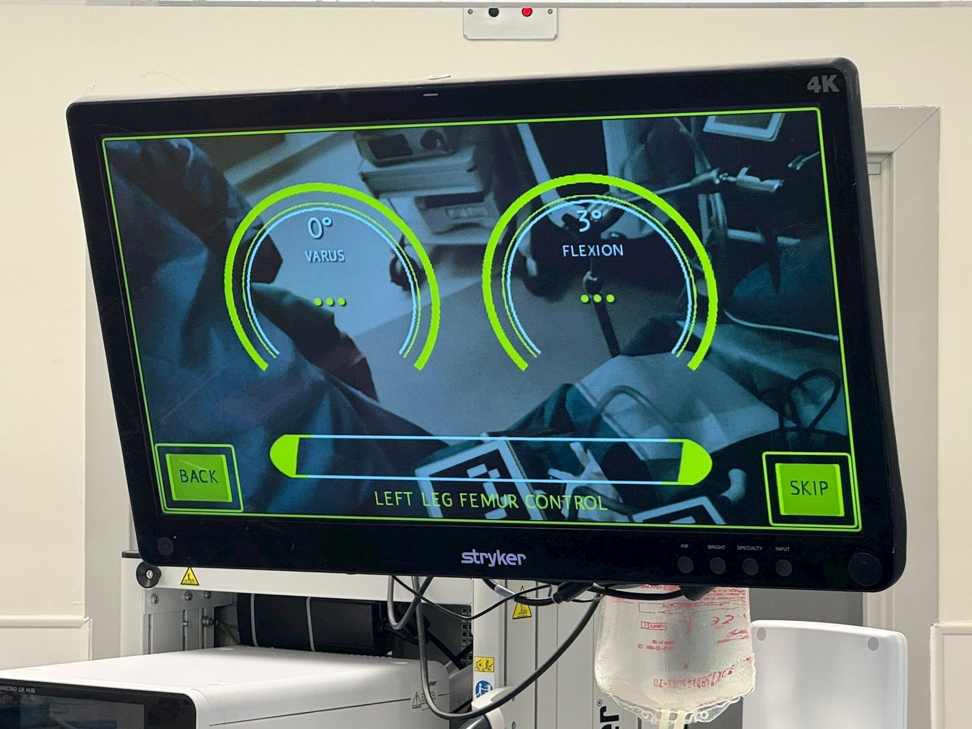 Pixee augmented reality system showing knee alignment during surgery